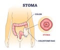 Stoma bag after colon surgery as medical patient drainage outline diagram