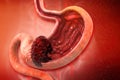 Stomach cancer. Cancer attacking cell. Stomach disease concept Royalty Free Stock Photo