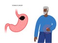 Stomach cancer concept