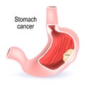 Stomach cancer. Cross section of the stomach Royalty Free Stock Photo