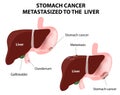 Stomach cancer Metastasized to the liver