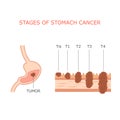 Stomach cancer stages,