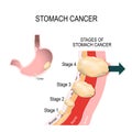 Stomach cancer. Vector illustration for medical use Royalty Free Stock Photo