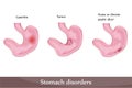 Stomach disorders