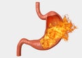 Stomach fire. excessive acidity, indigestion, stomach disease, gastric ulcer, severe abdominal pain