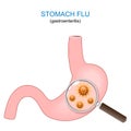 stomach flu. Human stomach, magnifying glass, and viruses