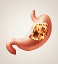 Stomach heartburn concept Royalty Free Stock Photo