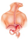 Stomach - Peptic Ulcer