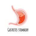 The stomach of a person with gastritis. Gastroenterology. Vector illustration in a flat style.