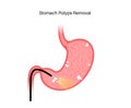 Stomach polyp removal