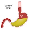 Stomach polyps. Cross section of human stomach with Gastric polyp