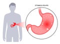 Stomach polyp disease