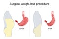 Stomach reduction. Vertical sleeve gastrectomy