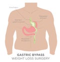 Stomach Staple Bariatric Surgery