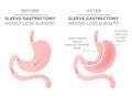 Stomach Staple Bariatric Surgery