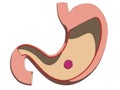 Stomach ulcer Royalty Free Stock Photo