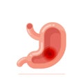 Stomach ulcer concept flat design Royalty Free Stock Photo