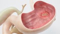 Stomach ulcer - high degree of detail - 3D Rendering Royalty Free Stock Photo