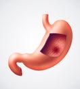 Stomach ulcer