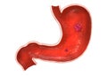 Stomach ulcer/tumor Royalty Free Stock Photo