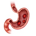 Stomach Ulcers