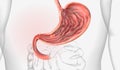 Stomach ulcers (gastric ulcers) are open sores that develop on the lining of the stomach