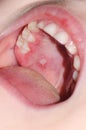 Stomatitis and herpes in the child mouth close-up