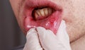 Stomatitis on the lips