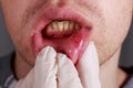 Stomatitis on the lips Royalty Free Stock Photo