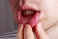 Stomatitis on the lips