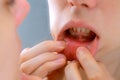 Stomatitis in woman's mouth after dental treatment cure, disease in the mouth.