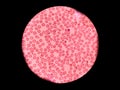 Stomatocytes in peripheral blood. Blood smear -Hematology.