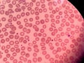 Stomatocytes in peripheral blood. Blood smear -Hematology.