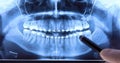 Stomatologist analysing dental radiography with braces