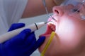 Stomatologist dentist makes ultrasonic cleaning teeth to woman, closeup view.