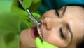 Stomatologist drilling female patients tooth, preparation for sealant placement