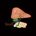 Stone bile duct. Gallbladder, duodenum, pancreas, bile ducts. Vector illustration