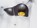 stone in the liver, schematic image, a large gallstone, the result of gallstones