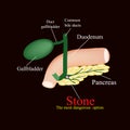 Stone pancreatic bile duct. The gall bladder, duodenum, bile ducts. Vector illustration on a black background