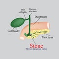 Stone pancreatic bile duct. The gall bladder, duodenum, bile ducts. Vector illustration on a gray background