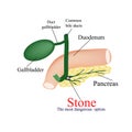 Stone pancreatic bile duct. The most dangerous