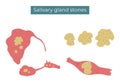 Stones in the parotid, submandibular and sublingual salivary glands and duct