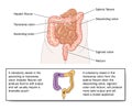 Stool quality of various colostomies