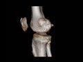 CT Scan of right knee 3d rendering image rotating on the screen and 2D sagittal view with knee slab showing fracture tibia bone.