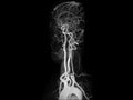 MRI and MRA Brain of the blood vessels in the brain and cerebrovascular disease. brain stroke x-ray image.Medical footage concept.