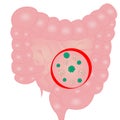Stop Virus infection in small intestine sign