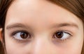 Strabismus. Close-up part child's face, eyes girl. Little patient strabismus, treatment ophthalmic diseases Royalty Free Stock Photo