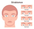 Strabismus. Cross eyed vision condition types. Esotropia, exotropia Royalty Free Stock Photo