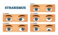 Strabismus or cross eyed vision condition, vector illustrations