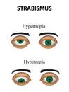 Strabismus. Hypertropia. Hypotropia. Infographics. Vector illustration on isolated background Royalty Free Stock Photo